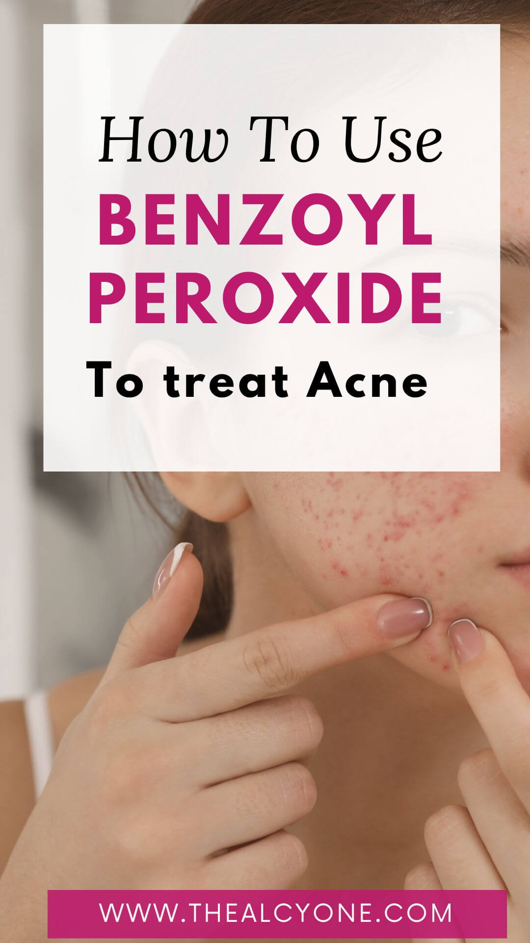 How To Use Benzoyl Peroxide To Treat Acne - The Alcyone