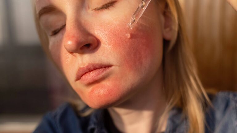 Rosacea causes, triggers, and the one skincare routine that actually works for sensitive skin.