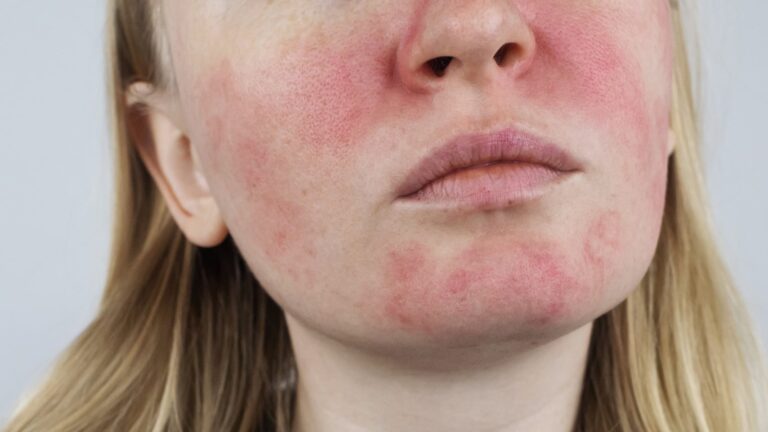 If your rosacea redness keeps winning, you have not tried azelaic acid and this complete guide will change that.