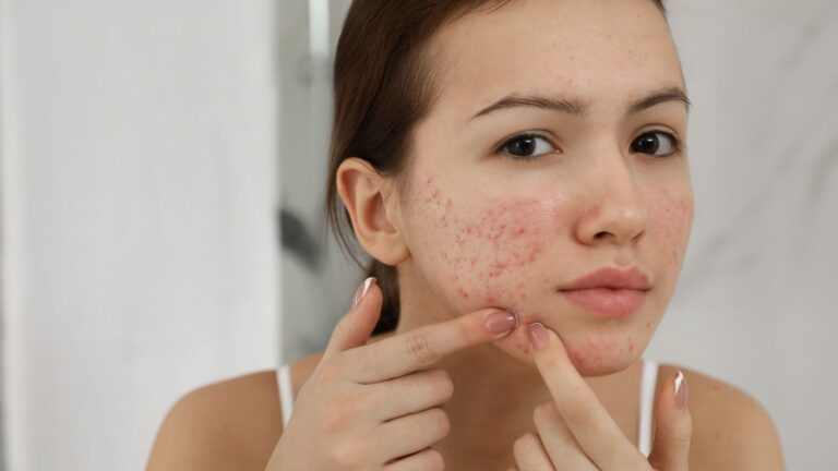 Your skin is breaking out because your gut is unhappy and these are the best foods to fix both at the same time.