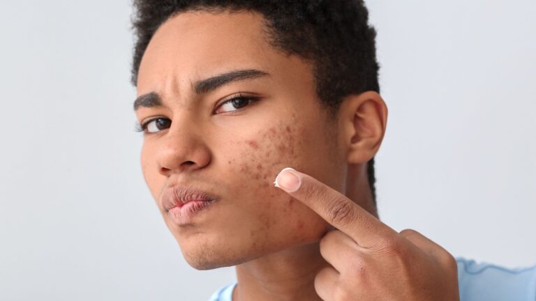 Your acne treatment might be failing for a reason that has nothing to do with the product and everything to do with one of these 10 causes.