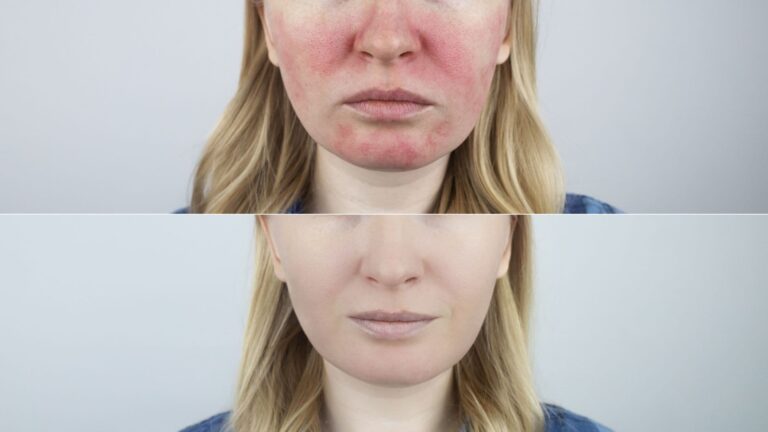 There is no cure for rosacea but these 10 natural remedies will calm the redness down significantly and yes you can start today.
