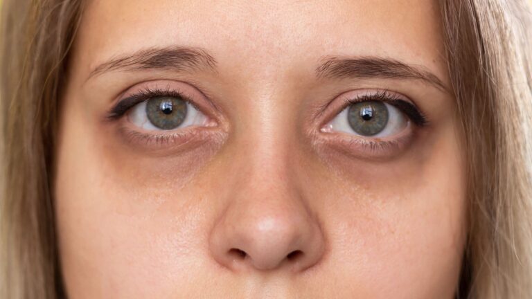 7 reasons you always have dark circles under your eyes and spoiler alert it is probably not the sleep you keep blaming.